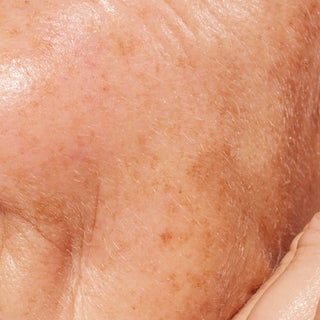 Une prise de vue macro extrême mettant l’accent sur la texture d’une peau mature. La surface présente un teint irrégulier caractérisé par de nombreuses petites taches de rousseur, taches solaires et zones plus larges d’hyperpigmentation brune sur la joue et la tempe.