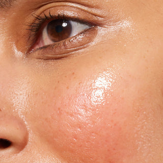 Un gros plan extrême du milieu du visage, centré sur la joue et la zone sous l’œil. La peau présente un fini hydraté et lumineux, avec une zone localisée de rougeur rosée marquée et une légère irritation au centre de la joue.