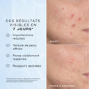 Before and after skin treatment results with text on a blue background