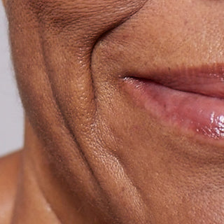 Un gros plan extrêmement recadré de la partie inférieure du visage, mettant l’accent sur le coin de la bouche et la joue. La peau aux tons foncés présente des sillons nasogéniens profonds, des rides du sourire visibles et une perte d’élasticité, mettant en avant les préoccupations liées à la fermeté et au relâchement cutané.
